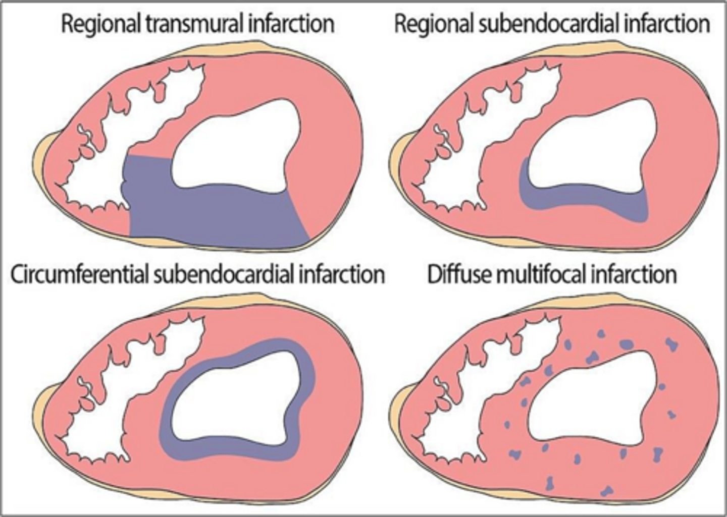<p>Type I is caused by acute plaque rupture leading to thrombosis, while Type II results from a supply-demand mismatch without acute thrombosis.</p>