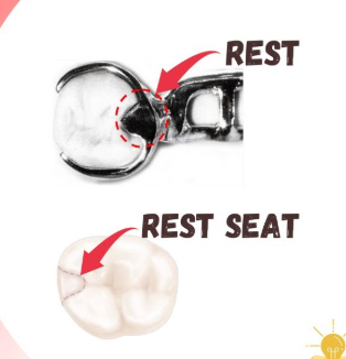 <ul><li><p>type of direct retention </p></li><li><p>prepared recess in tooth or restoration created to receive the occlusal, incisal, cingulum or lingual rest </p></li></ul><p></p>