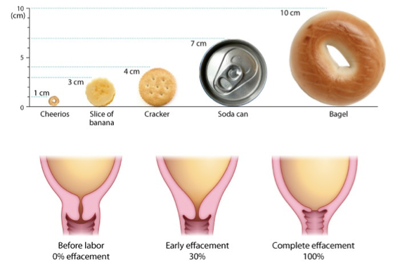 <ul><li><p>stage 1 of parturition</p></li><li><p>prep birth canal for fetal passage</p></li><li><p>phase 1: effacement</p><ul><li><p>effacement= thinning of cervix</p></li><li><p>0→100% effacement of cervix</p></li><li><p>preps cervix to start dilating</p></li></ul></li><li><p>phase 2: dilation</p><ul><li><p>cervix dilates from 1→ 7cm</p><ul><li><p>1 cm= cheerio</p></li><li><p>4 cm= cracker</p></li><li><p>7 cm= soda can</p></li></ul></li><li><p>contractions become longer, stronger, more frequent</p></li><li><p>lasts 5-9 hrs (1st baby birth) or 2-5 hrs (subsequent births)</p></li></ul></li><li><p>phase 3: transition</p><ul><li><p>cervix dilates from 7→ 10 cm</p><ul><li><p>10 cm= bagel</p></li></ul></li><li><p>most intense and painful phase</p></li><li><p>contractions last 60-90 secs, very close together</p></li><li><p>fetus moves into pelvic basin, creating urge to push</p></li><li><p>ends when full dilation (10 cm) is reached→ ready for delivery</p></li></ul></li><li><p>effacement contractions→ dilation of cervix→ transition</p></li></ul><p></p>