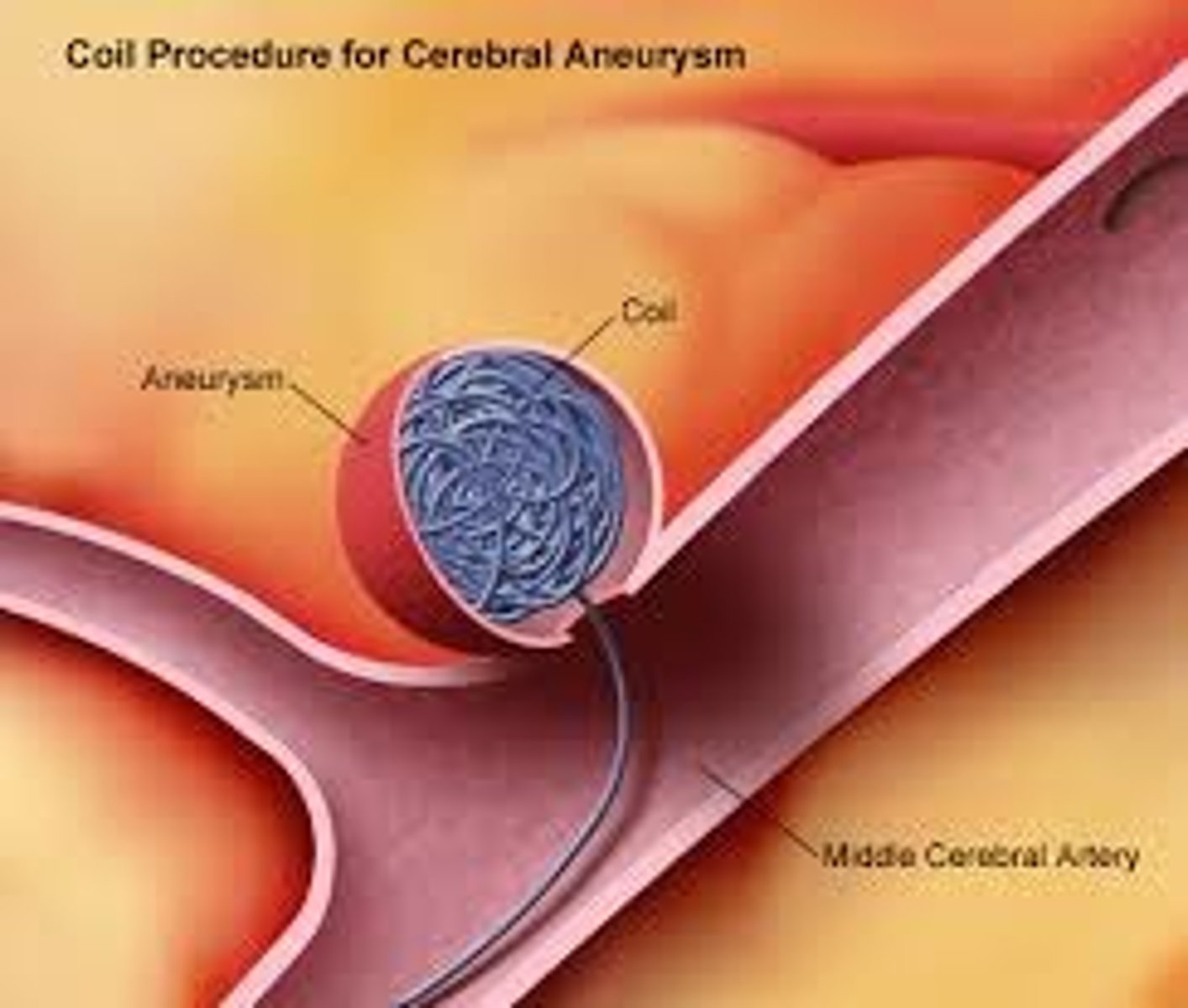 <p>Placement of catheter via femoral artery to area of aneurysm. Multiple small coils are placed/packed eventually leading to clot formation preventing continued bleeding</p>