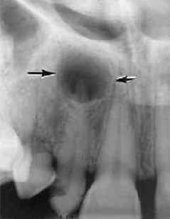 <p>less dense tissue (e.g. pulp, periapical lesions)</p>