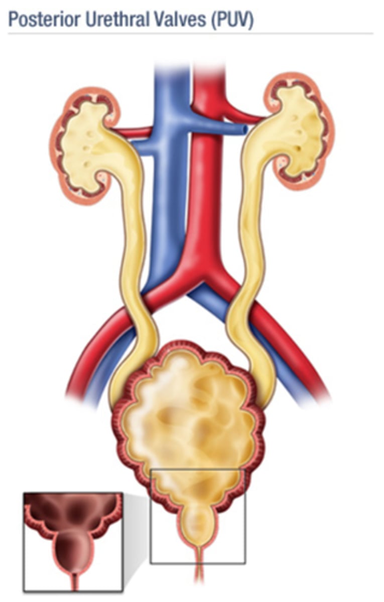 <p>Posterior urethral valves</p><p>- progressive dilation of bladder, ureters, kidneys</p><p>- US shows bladder distention, B/L hydroureters, B/L hydronephrosis</p>
