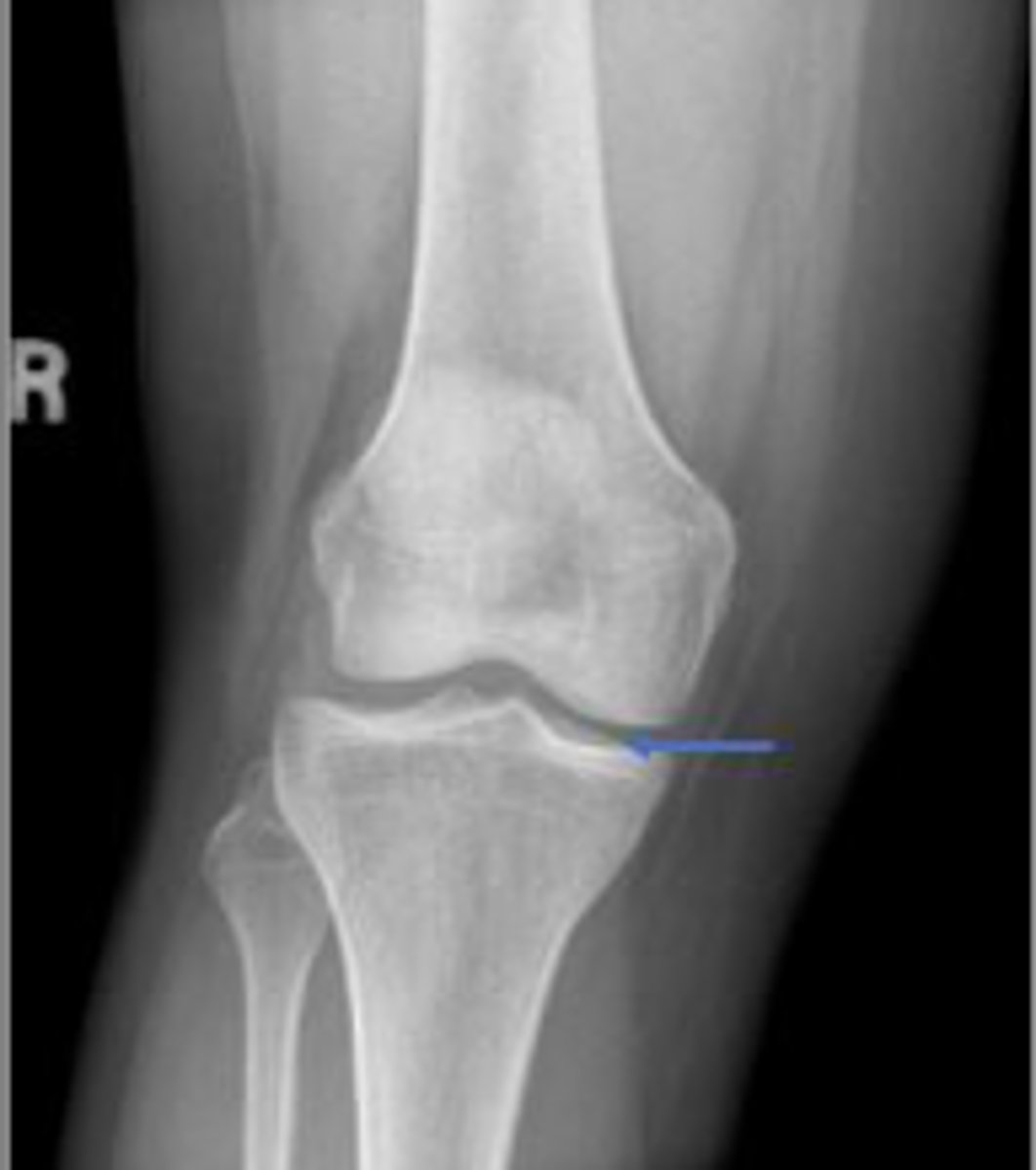<p>What joint space is the arrow pointing to?</p>