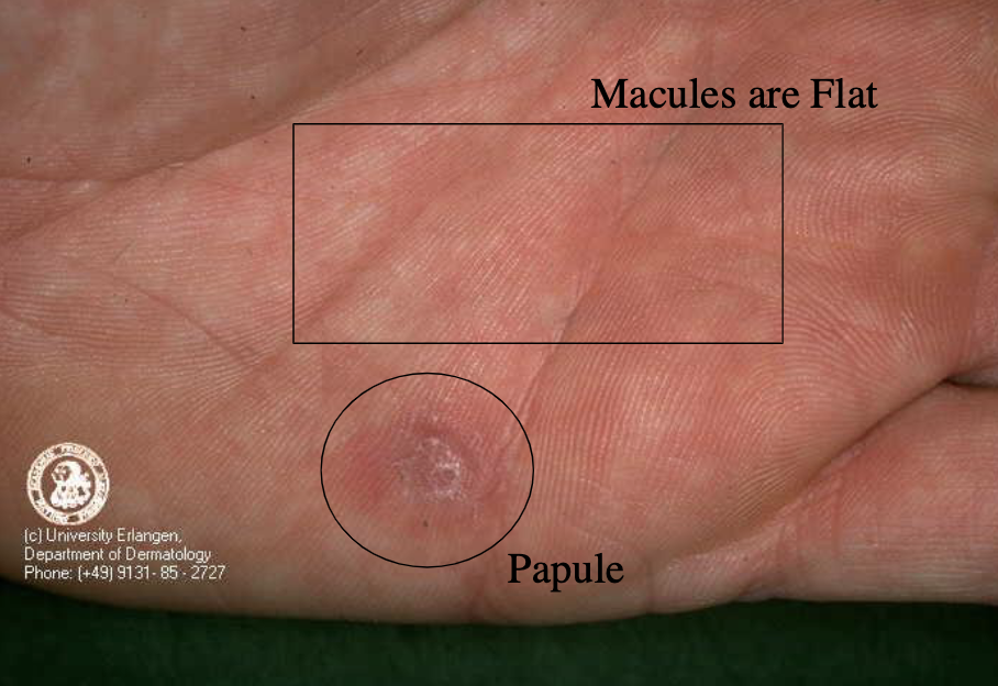 <p>(secondary syphilis)</p>