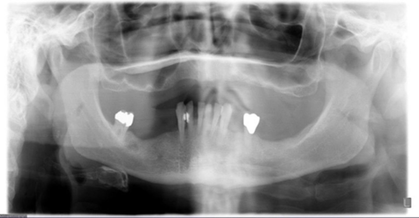 <p>ID the calcified abnormality:</p>