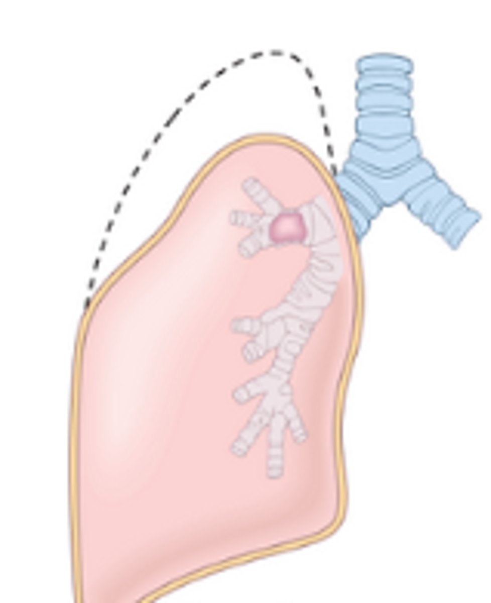 <p>Collapse of alveoli</p>