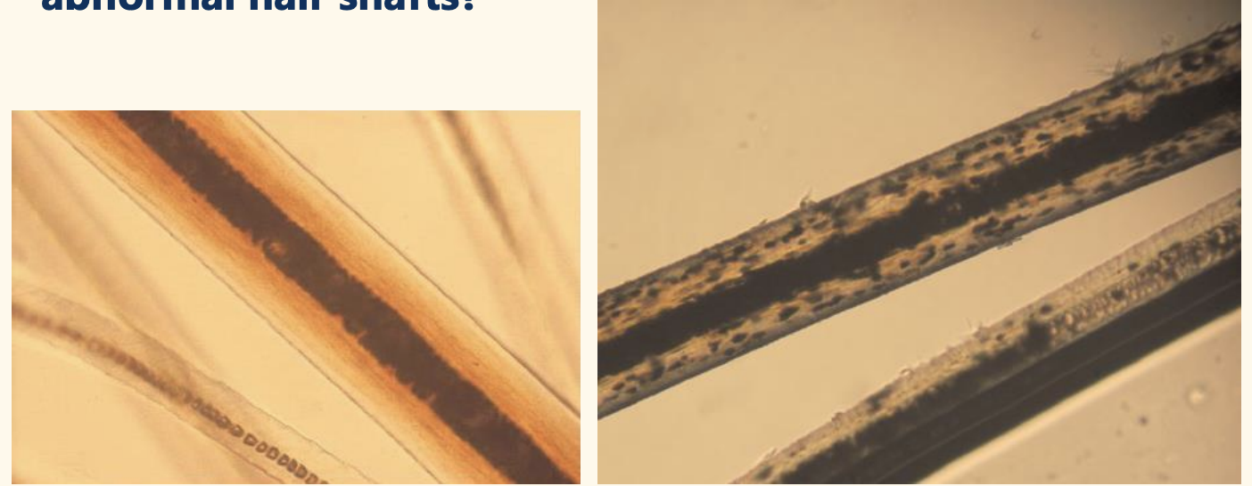 <p>Normal or abnormal hair shafts?</p>