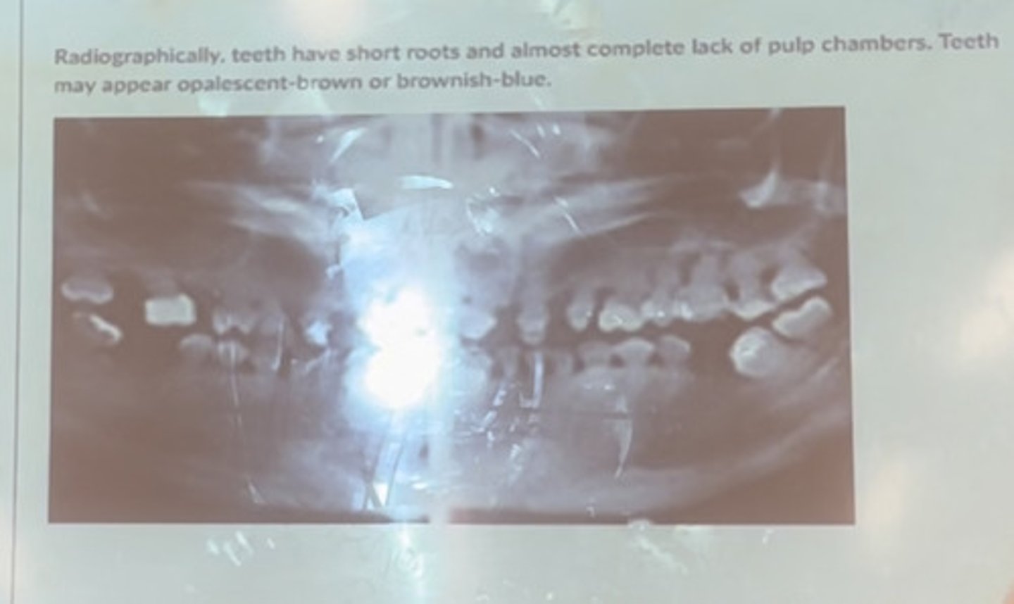 <p>Radiographically, teeth have short roots and almost complete lack of pulp chambers. Teeth may appear opalescent-brown or brownish-blue</p>