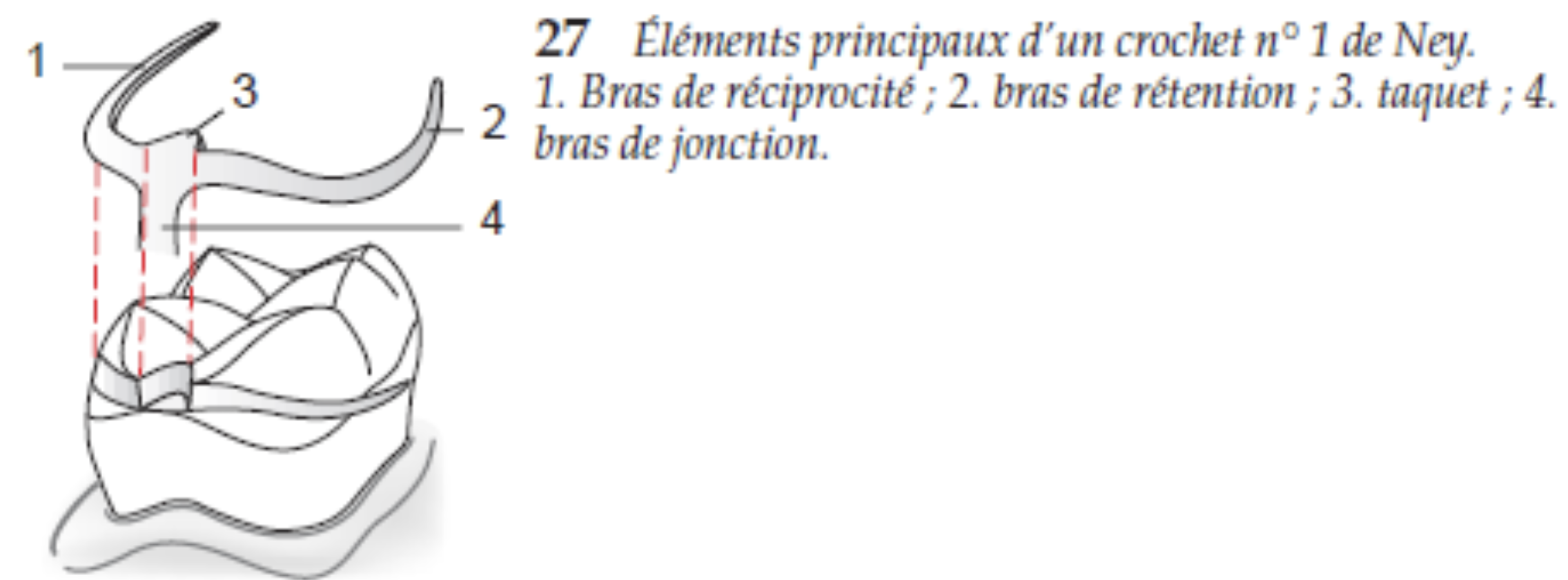 <p><strong>Description : </strong></p><ul><li><p>1 potence </p></li><li><p>1 bras vestibulaire </p></li><li><p>1 bras lingual/palatin </p></li><li><p>Taquet en forme de cuillère du côté de l’édentement </p></li><li><p>Potence du côté de l’édentement </p></li></ul><p></p><p><strong>Indication : </strong></p><ul><li><p>Dent bordant un édentement encastré </p></li></ul><p></p>