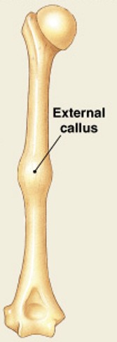 <p>Which step of fracture repair have:</p><ul><li><p><span style="color: yellow;"><strong>Osteoblasts and osteocytes remodel the fracture</strong></span> for up to a year</p></li></ul><p></p>