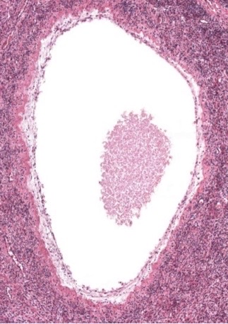 atretic follicle, corpus luteum, or corpus albicans?