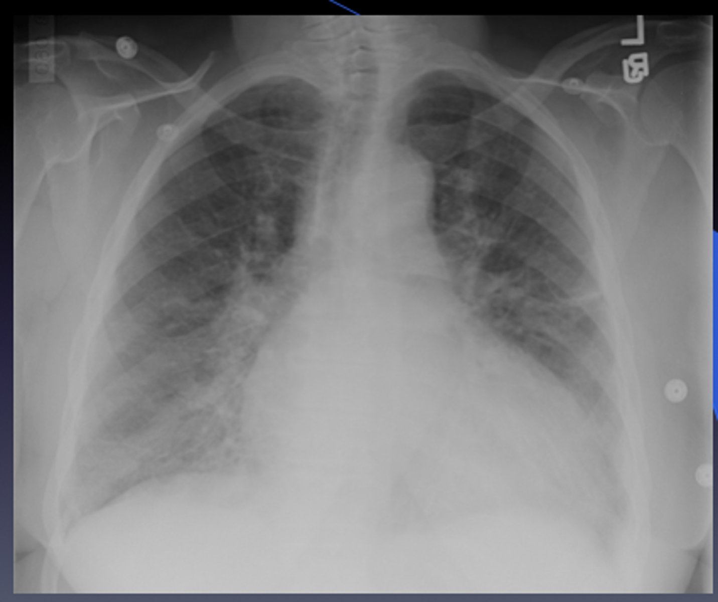 <p>-HTN (hypertension)</p><p>-CHF (congestive heart failure)</p><p>-Diabetic neuropathy - kidney disease in diabetic;</p>