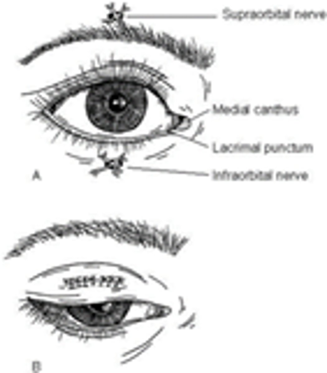 <p>-Exam to check all associated structures</p><p>- Evert the lid to see if went all the way through (if so, do thorough globe exam)</p>