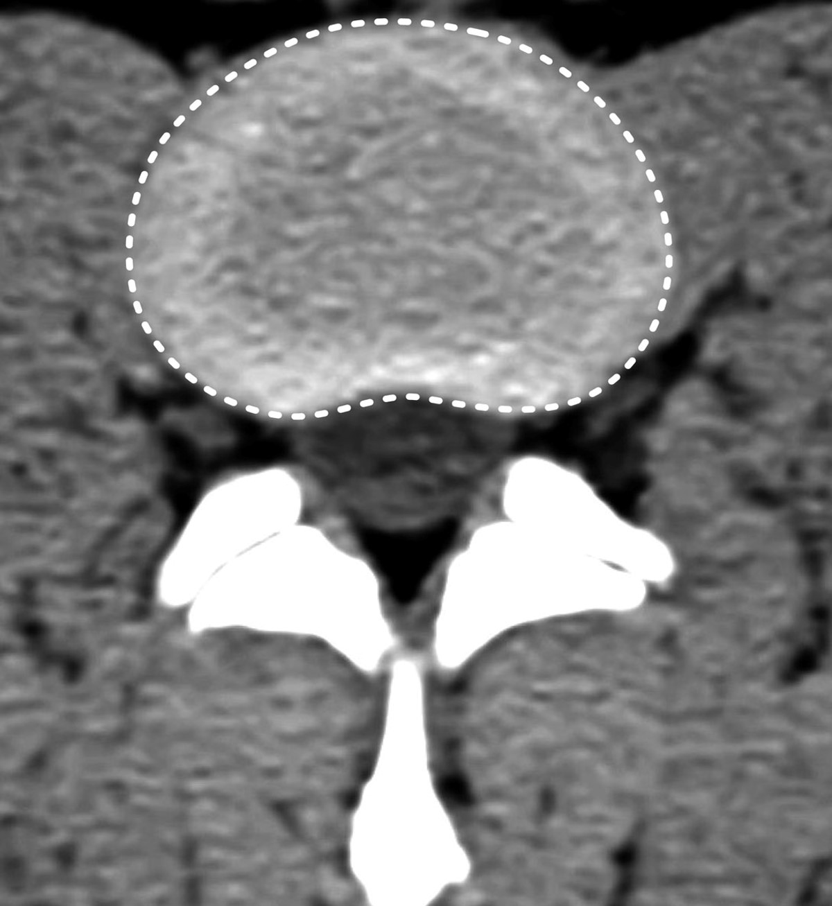 <p>Base wider than the dome</p><p>Confined to disc level</p><p>Outer annular fibers intact</p><p>Involves less than 90 degrees of the disc circumference</p>