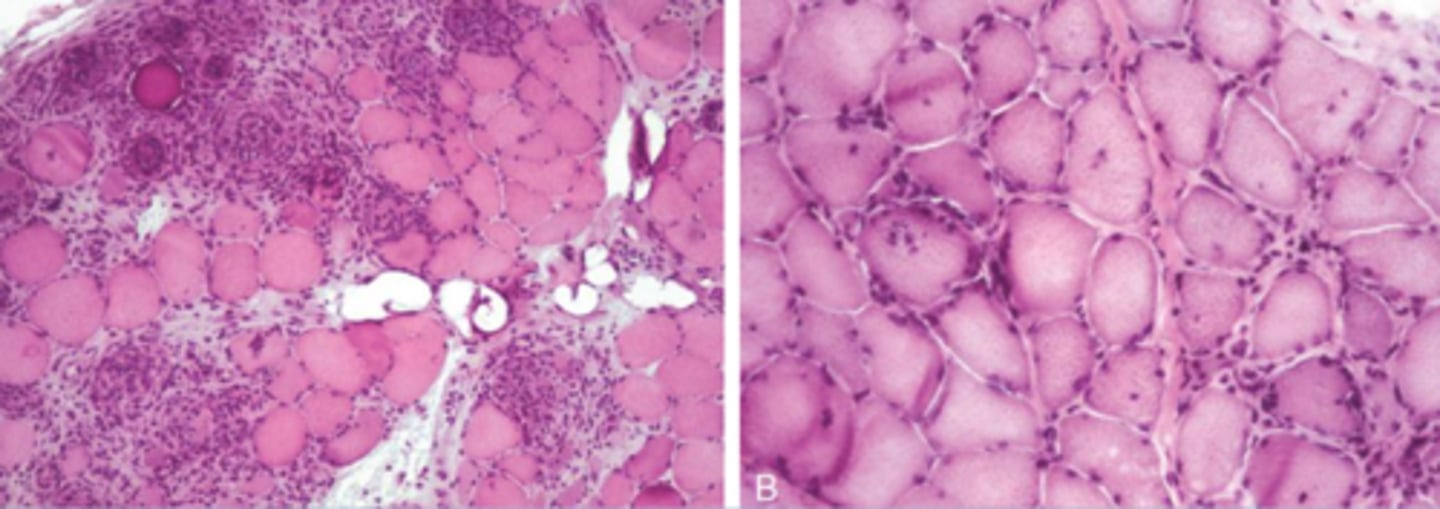 <p>What is Polymyositis?</p>