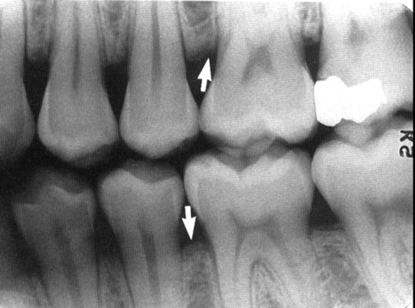 <p>Stage 1 perio</p>