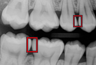 <p>Spaces where teeth do not touch, leaving a gap.</p>