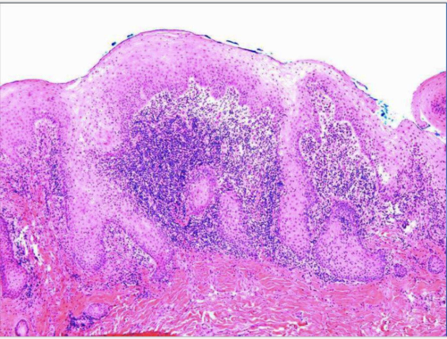 <p>The following describes the histopathological features of what?</p><p>-papillary growths on surface</p><p>-may show pseudoepithliomatous hyperplasia</p><p>-sialadenitis</p>