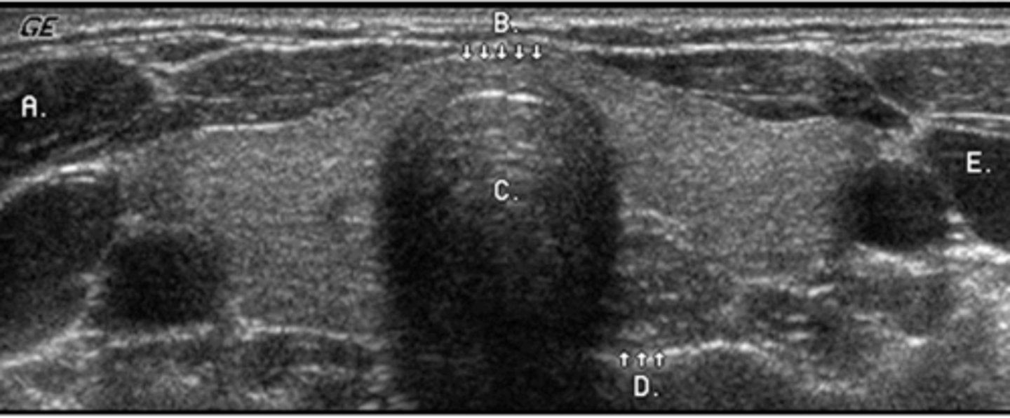 <p>Identify the structure labeled E</p><p>a. common carotid artery</p><p>b. internal jugular vein</p><p>c. external jugular vein</p><p>d. longus coli muscle</p><p>e. subclavian vein</p>