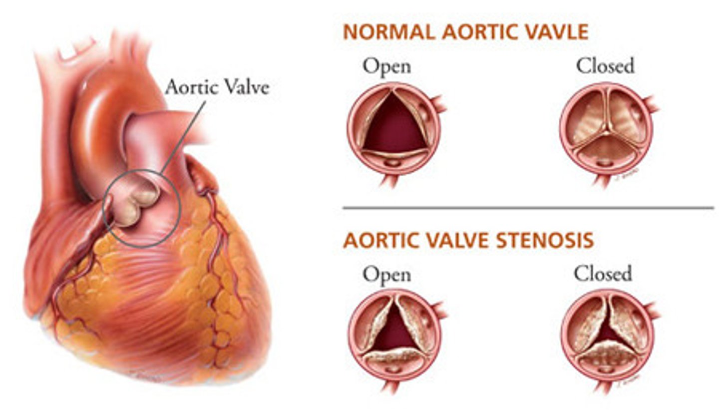 <p>- most common valvular abnormality</p><p>- orifice of the aortic semilunar valve narrows causing diminished blood flow from the left ventricle into the aorta</p>