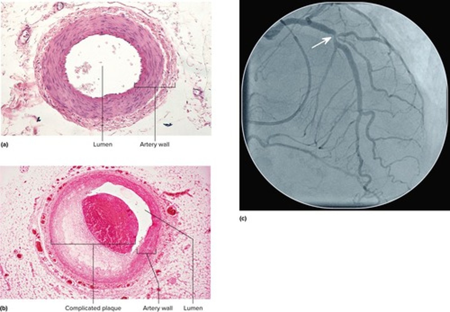 <p>A constriction of the coronary arteries, usually due to atherosclerosis.</p>