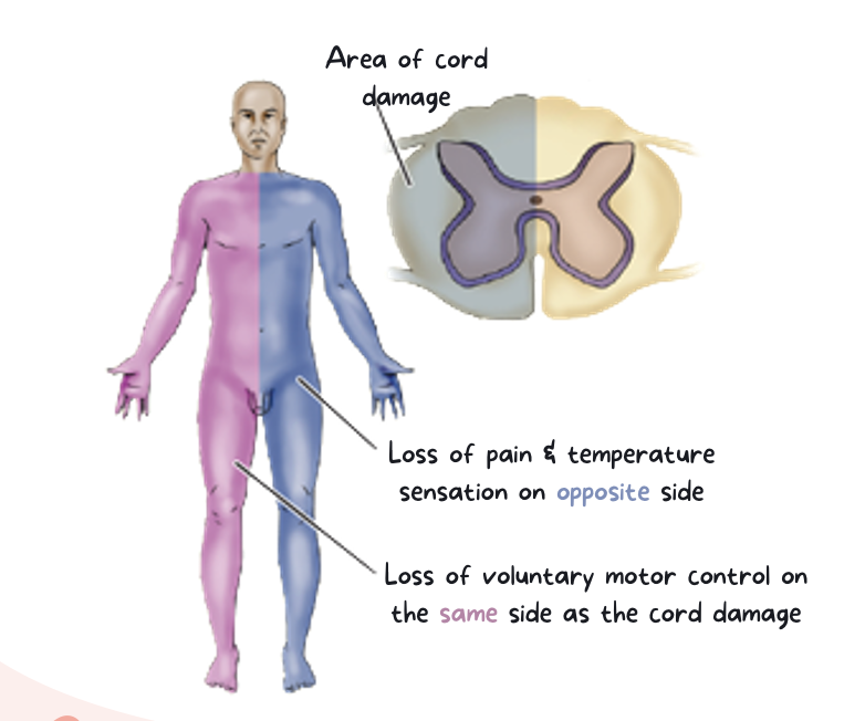 <p><strong><u>Cause</u></strong>:</p><ul><li><p>Transverse hemi-section of cord (north to south), usually from</p><ul><li><p>a knife or missile injury</p></li><li><p>fracture/dislocation of a unilateral articular process, or</p></li><li><p>possibly an acute ruptured disc</p></li></ul></li></ul><p><strong><u>Characteristics</u></strong>:</p><ul><li><p><span style="color: purple"><strong>Ipsilateral</strong> </span><em>paralysis</em> or paresis + loss of <em>touch</em>, <em>pressure</em> and <em>vibration</em> (<strong>same side</strong>)</p></li><li><p><span style="color: rgb(51, 154, 168)"><strong>Contralateral</strong></span> loss of <em>pain</em> and <em>temperature</em> (<strong>opposite side</strong>)</p></li></ul><p></p>