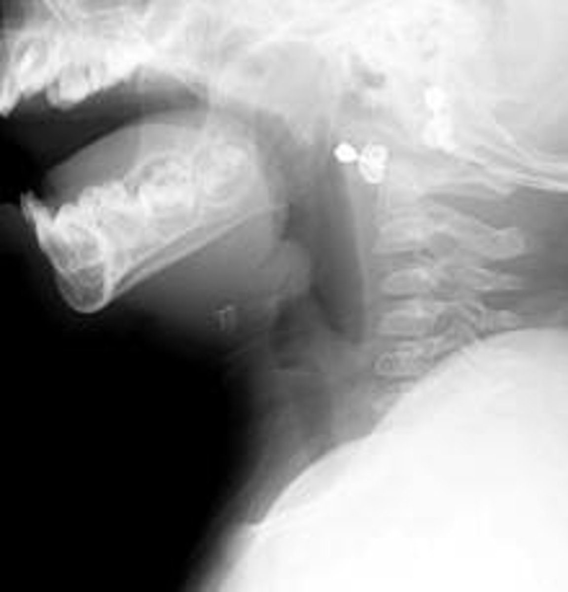 <p>What abnormality is shown here in this soft tissue neck x-ray? What would you diagnose this patient with?</p>
