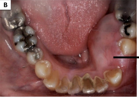 <p>Characteristic of cysts and tumors of jaw</p>