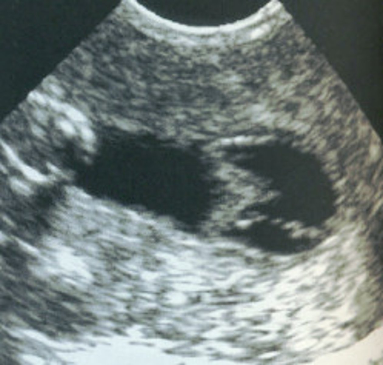 <p>process of recording the uterus using sound</p>