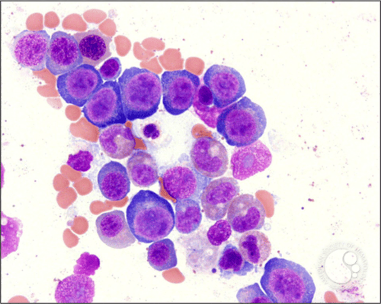 <p>- hypercellular <br>- ME ratio decreased (1:1, 1:3)<br>- nucleus doesn't mature with cytoplasm <br>- bands and giant metamyelocytes <br>- megakaryocytes= hypogranulation and hyperseg</p>