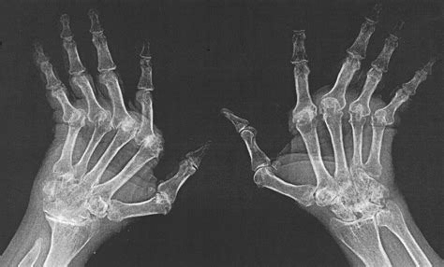 <p>autoimmune and inflammatory arthritis. located in proximal joints of hands and wrists, usually B/L</p><p>hands- erosions, ulnar deviation of fingers at MCPs, subluxation of MCPs, swan-neck and boutonniere deformities</p><p>wrist- erosions</p><p>larger joints usually show no erosions</p>