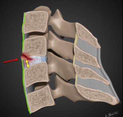 <p>Due to forced extension of the<br>neck with a resultant avulsion of<br>the antero-inferior corner of a<br>vertebral body by the anterior<br>longitudinal ligament.<br>• Stable in flexion but unstable in<br>extension.<br>• Not considered as serious as a<br>flexion tear drop fracture.<br>• Anterior disc space widening.<br>• Can result in cord damage</p>