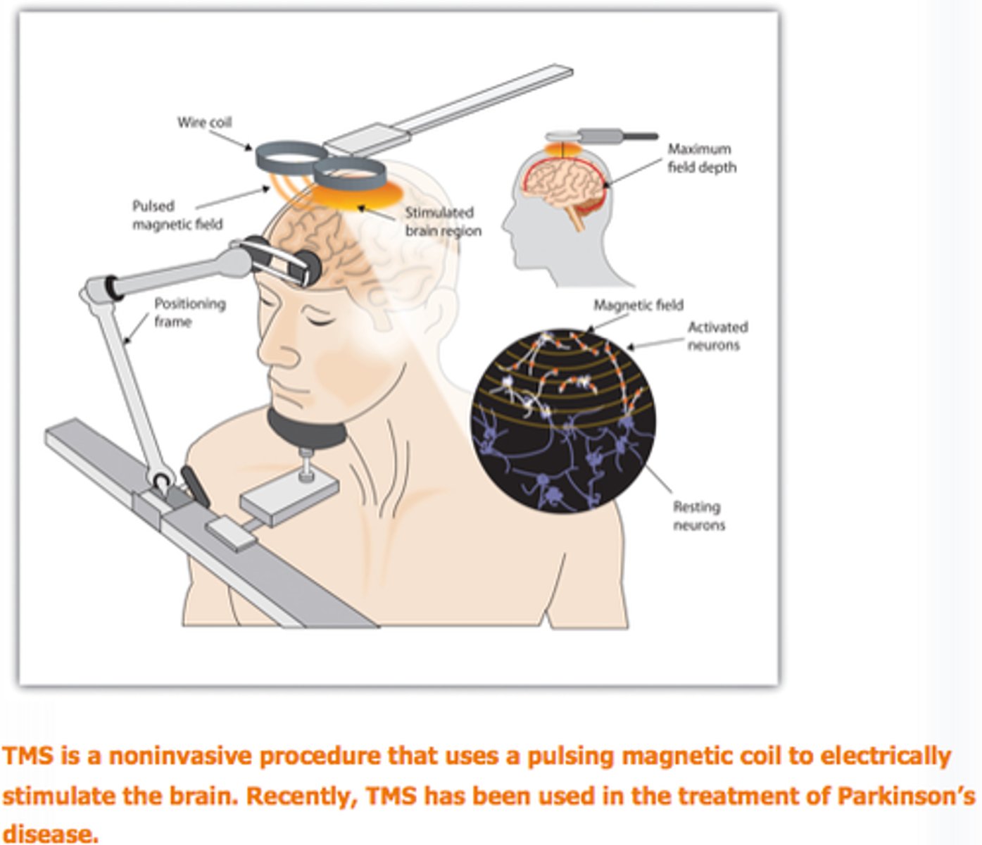 <p>a non-invasive intervention that uses magnetic fields to stimulate the brain (used for depression, obsessive-compulsive disorder, and other conditions)</p>
