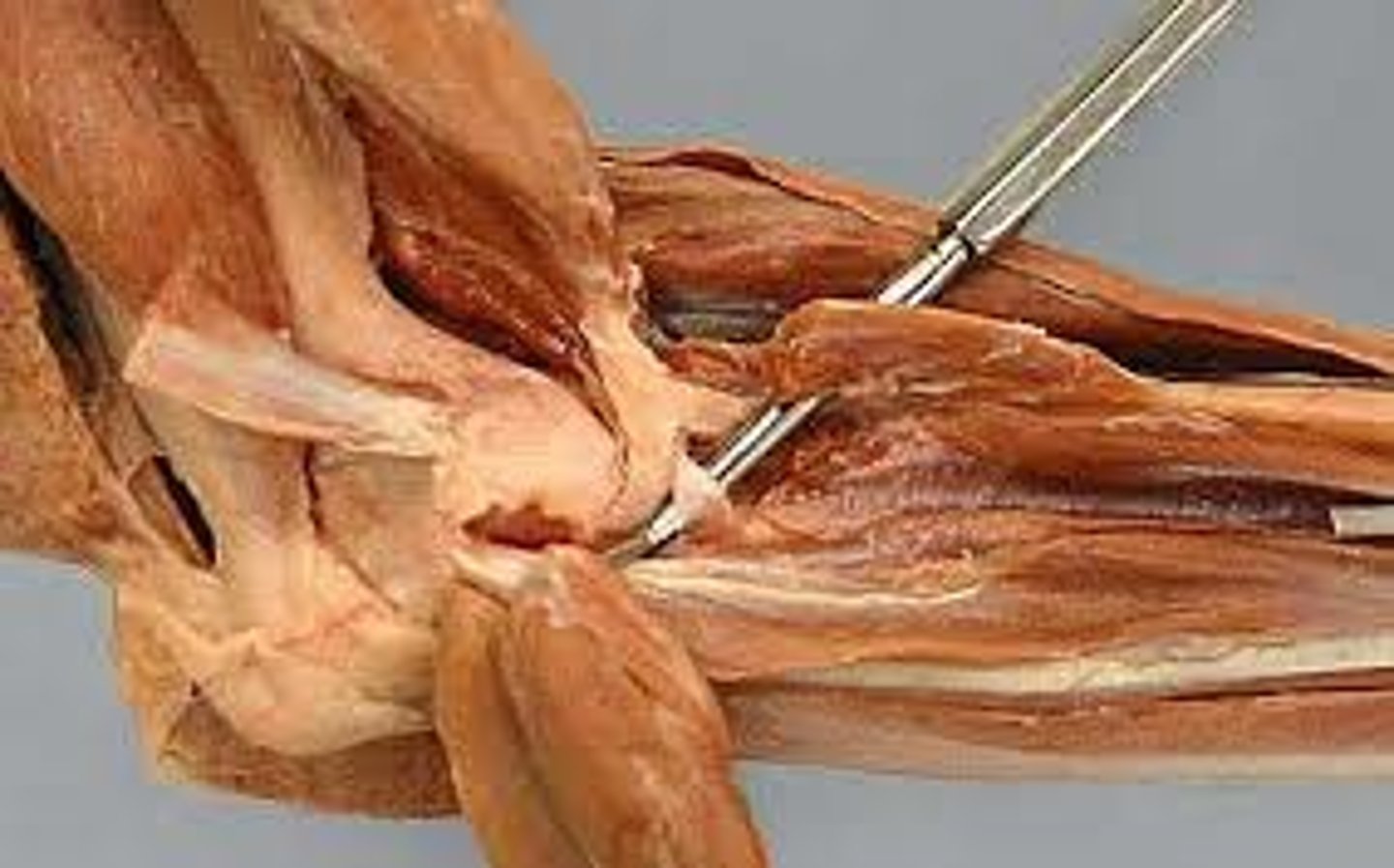 <p>What muscle is this?</p><p>Origin?</p><p>Insertion?</p><p>Action?</p><p>Nerve?</p>
