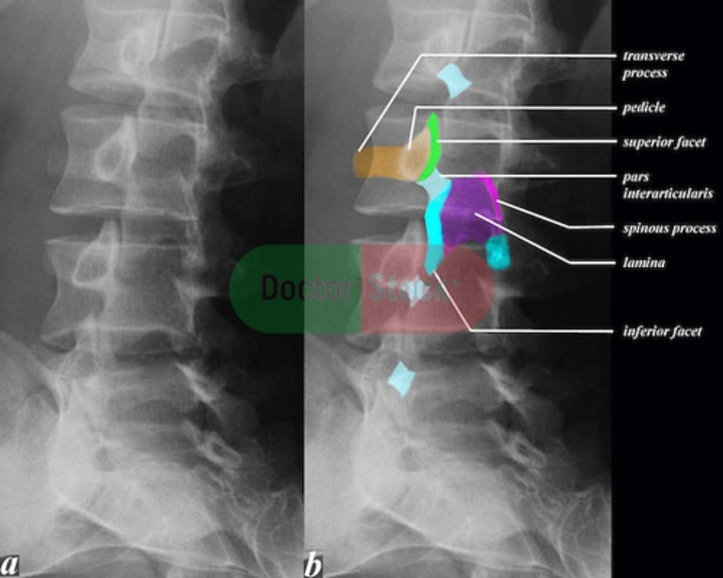 <p>pedicle</p>