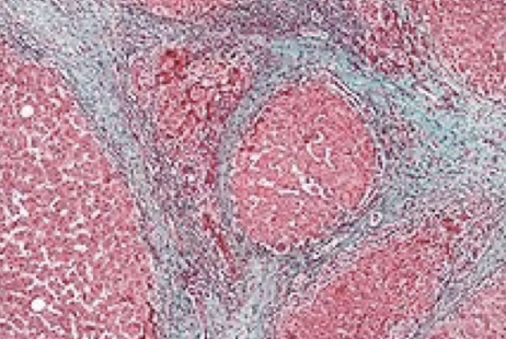 <p>excessive deposition of collagen and ECM components (excessive scarring) following a prolonged or chronic injury</p>