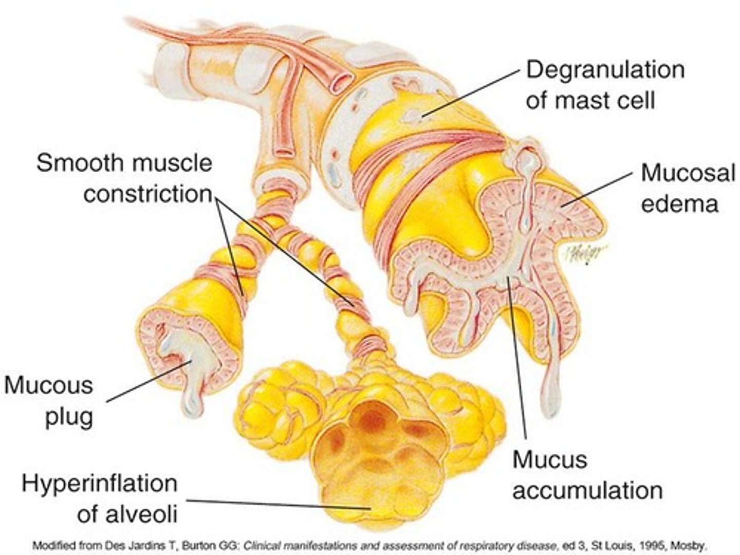 <p>Reversible airway obstruction characterized by airway inflammation and Type I hypersensitivity.</p>