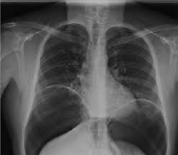 <p>Air trapped in the peritoneal cavity</p><p>Caused from tissue erosion, ischemia, infection, injury</p>