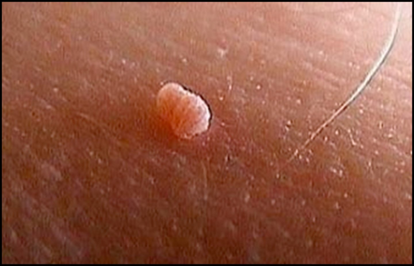 <p>Acrochordons </p><p>Can be a marker for insulin dependence</p><p>Flesh-colored to brown, often pedunculated, fleshy papules </p><p>Commonly on eyelids, axilla, neck and groin </p>