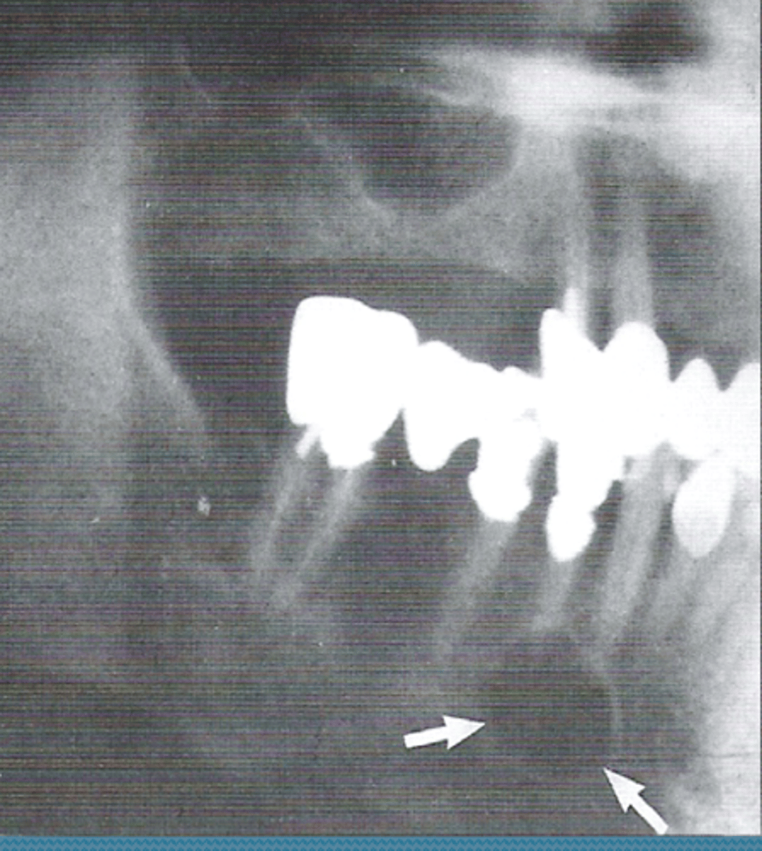 <p>radiolucent lesion that appears to extend up the PDL and between the roots</p>