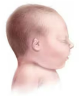 <p>What is the term used when structures of the pinna may be missing and/or the pinna may be smaller than expected? </p>