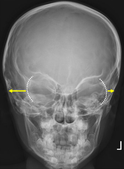<ul><li><p>MAIN Goal, F/E: petrous pyramids are projected into the lower 1/3 of the orbits</p></li><li><p>Tilt: supraorbital rims transversely aligned&nbsp;</p></li><li><p>Rotation: lateral border of the orbits equidistant to the lateral border of the cranium (rotation is towards the narrowed side)</p></li></ul><p></p>