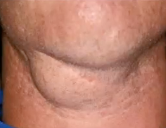 <p>painless swelling in floor of the mouth, no epithelial lining and has breached the mylohyoid muscle, diagnosis?</p>