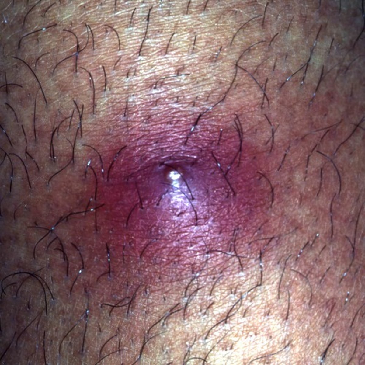 <p>Abscess of the hair follicle or sebaceous oil gland (Boil)</p>