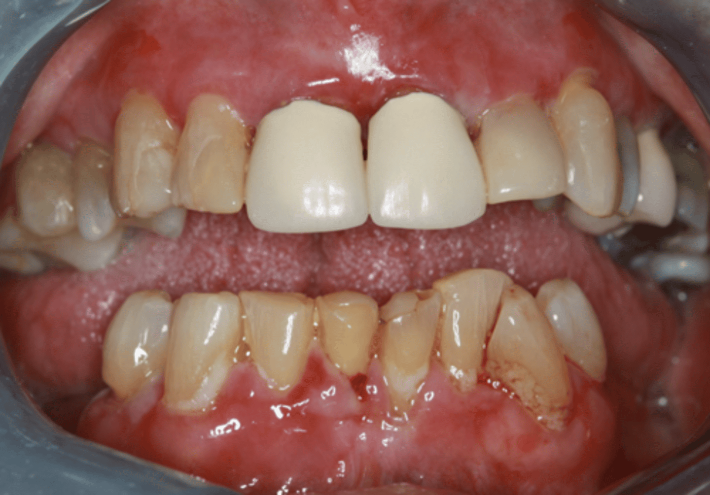 <p>Patient presents with these lesions along with ocular lesions including <strong>symblepherons, entropions, trichiasis</strong>. What is the most likley differential?</p>