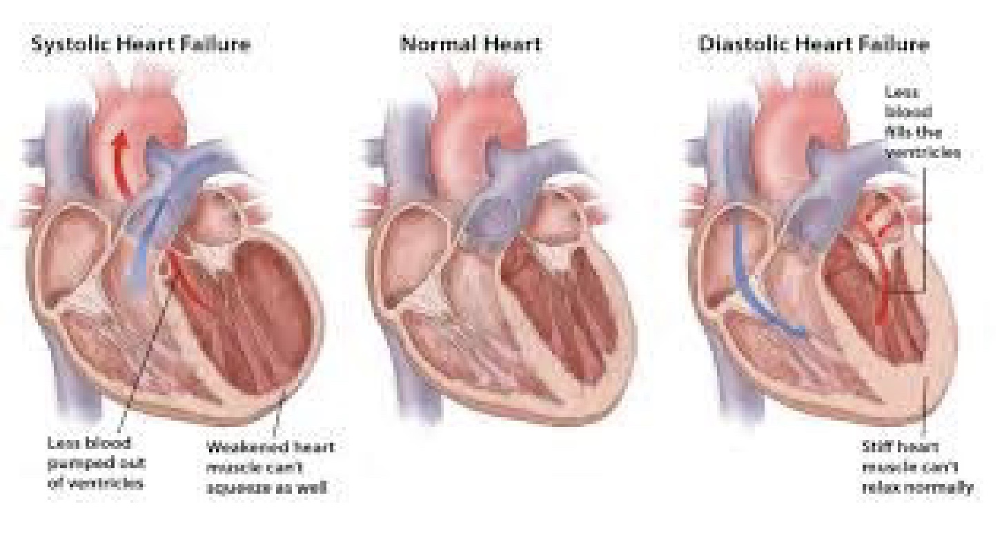 <p>-no longer squeezing adequately so <strong>inability to maintain Q and can’t meet metabolic demands of body</strong></p><p>-50% mortality rate next 5 years</p><p>*previous injury so at high risk; more likely in older aged people who show signs</p><p><u>Systolic Heart Failure</u></p><p>-big chambers, so can’t generate enough force to get blood out</p><p>-more seen in older aged</p><p>-treat w/ high contractility using meds, pacemakers, etc. (easier to treat)</p><p><u>Diastolic Heart Failure</u></p><p>-ventricle really thick, so small chamber and squeez well but not fill well; significant afterload</p><p>-hard to treat bc can’t make chamber bigger</p>