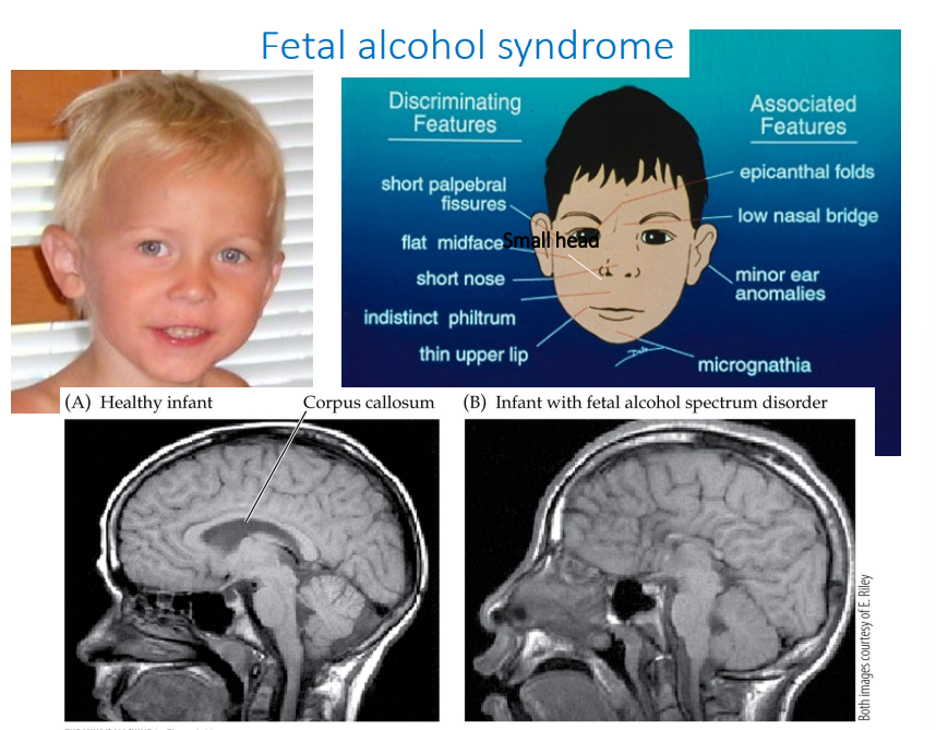 <p>Fetal alcohol syndrome</p>