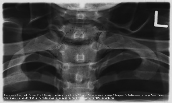 <p>Lateral manubrium and medial ends of clavicles.</p>