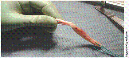 <p><span style="font-family: Lato Extended, Lato, Helvetica Neue, Helvetica, Arial, sans-serif">This picture shows prepared ACL graft.</span></p>