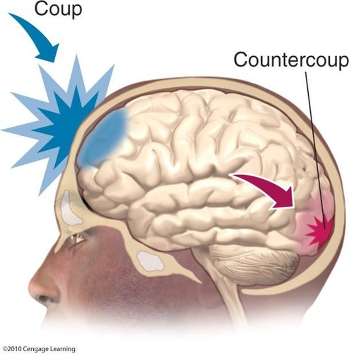 <p>Involve penetration of the skull and have worst consequences when affecting ventricles, both hemispheres, and multiple lobes of the brain</p>